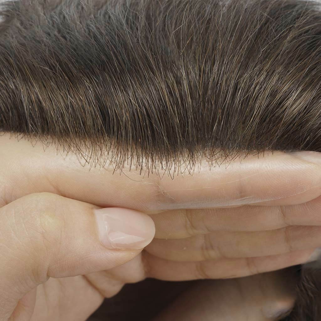 Implantation des cheveux sur la ligne frontale
